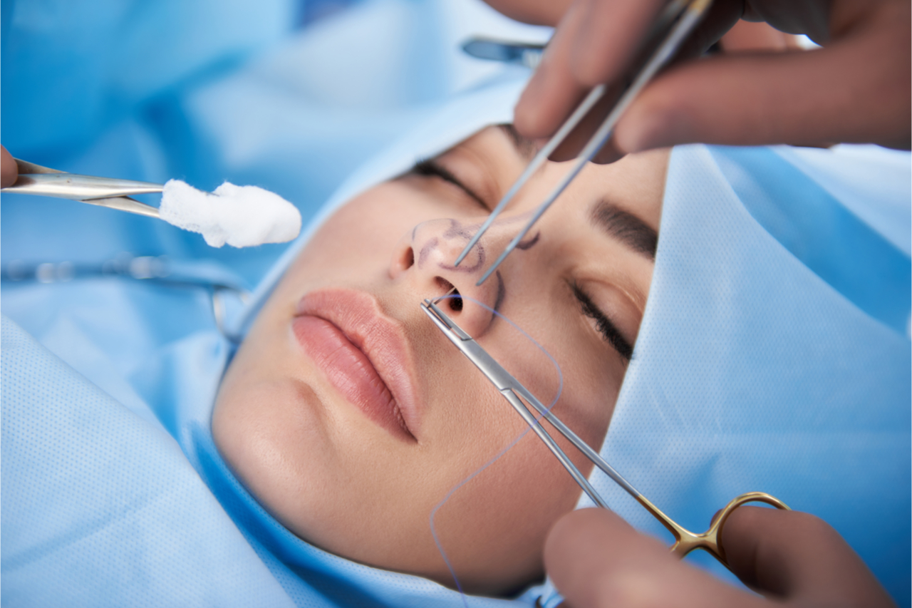 rinoplastie